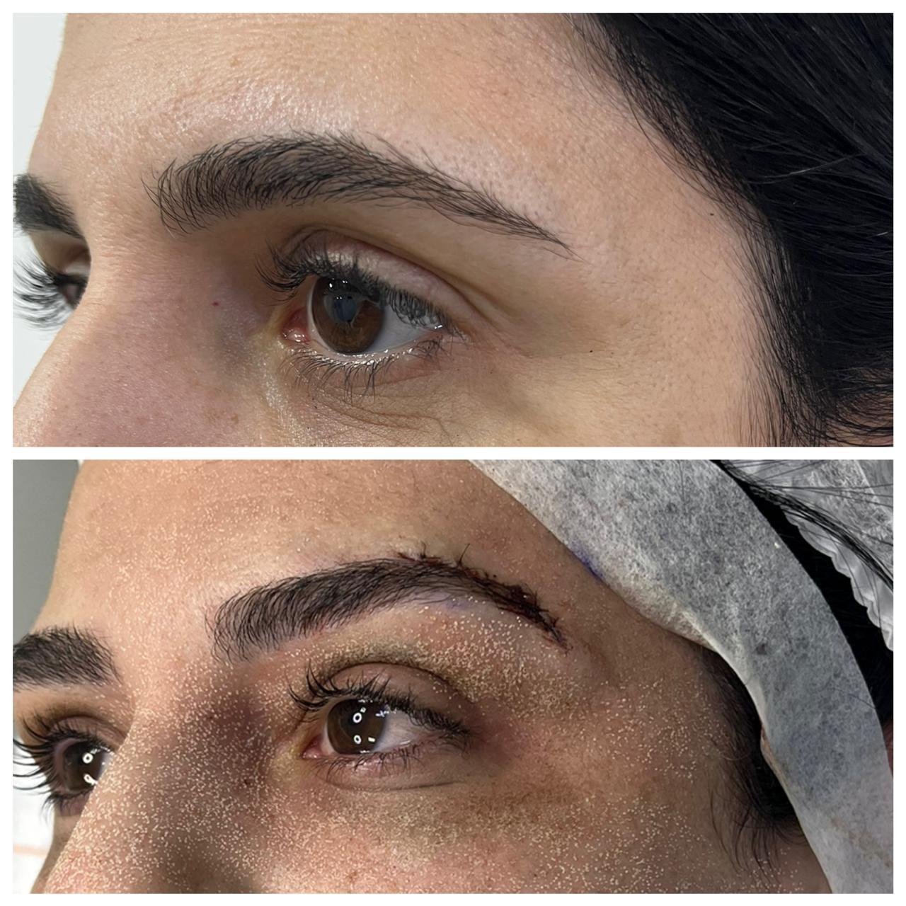 Antes e depois do Lifting de Sobrancelha (Castanhares) — Dr. Humberto Rocha